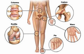 Articulaciones a las que afecta la artrosis